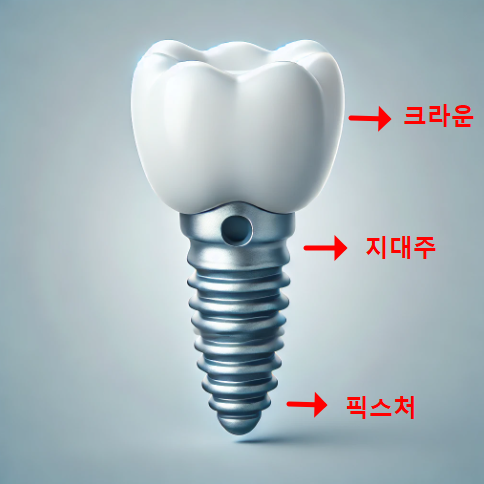 픽스처(잇몸 기둥)

지대주(어버트먼트)

크라운